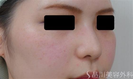 症例NO.34230のBEFORE写真