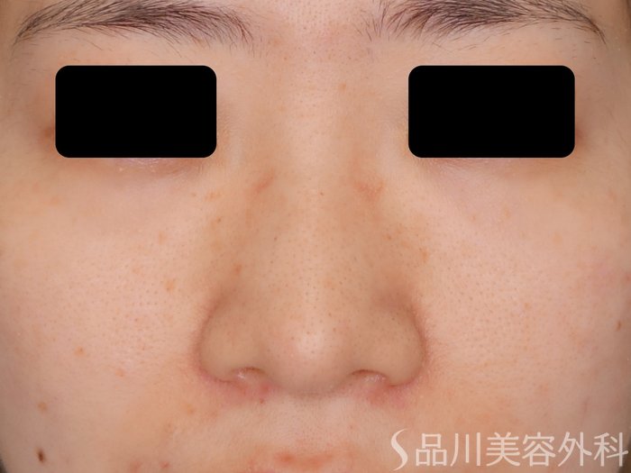 症例NO.70609のBEFORE写真