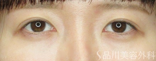 症例NO.70398のAFTER写真