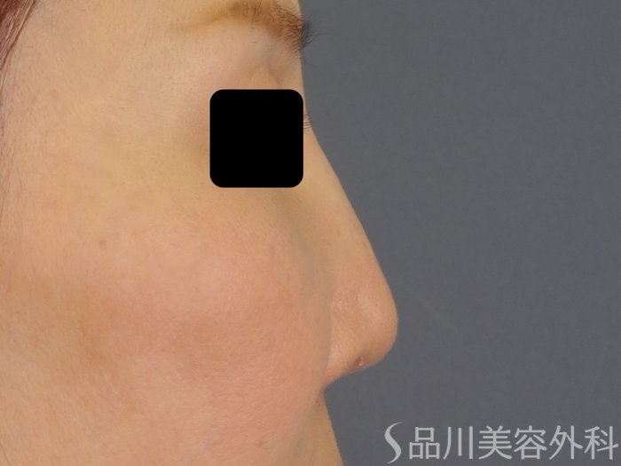 症例NO.72841のAFTER写真