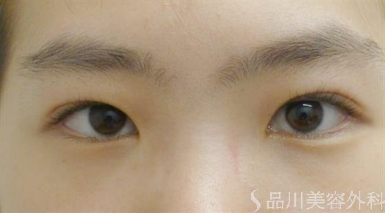 症例NO.35688のAFTER写真
