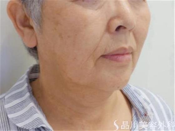 症例NO.35933のBEFORE写真