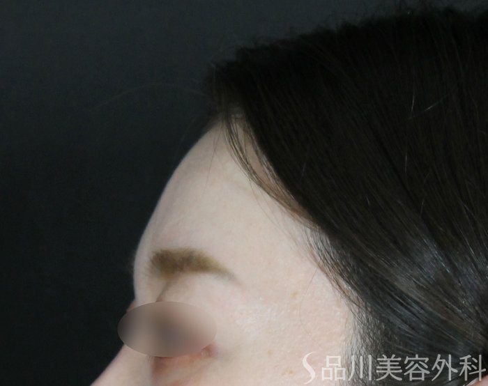 症例NO.73419のBEFORE写真