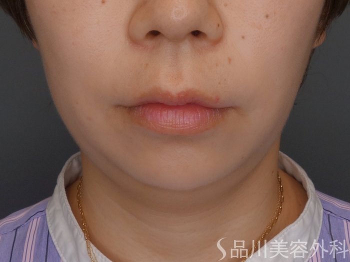 症例NO.65670のBEFORE写真