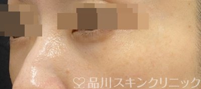 症例NO.62588のAFTER写真