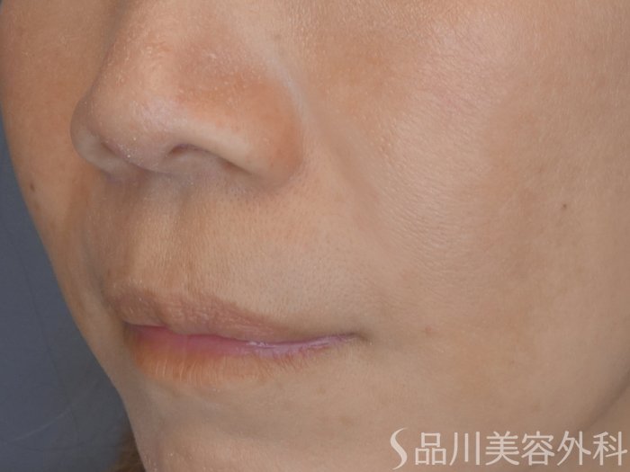 症例NO.69507のAFTER写真