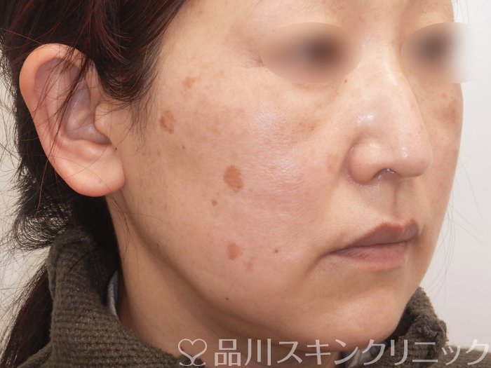 症例NO.62471のBEFORE写真