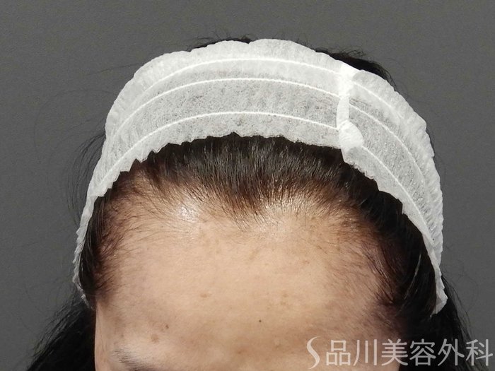 症例NO.65013のBEFORE写真