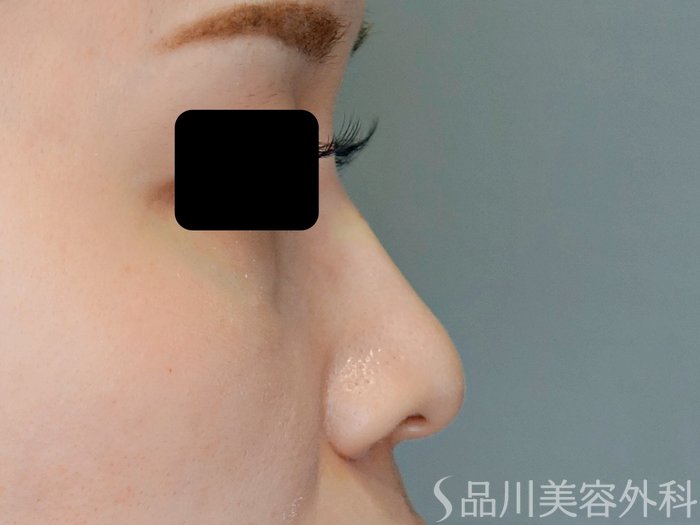 症例NO.71124のAFTER写真