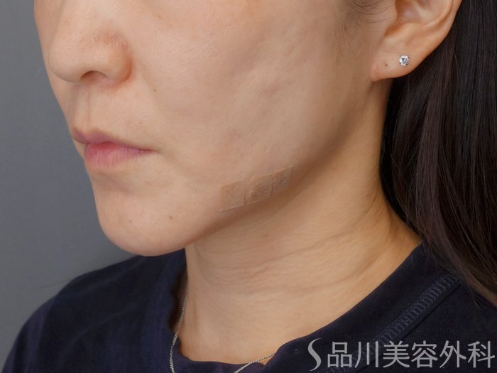 症例NO.72696のAFTER写真