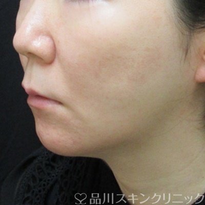 症例NO.69982のAFTER写真