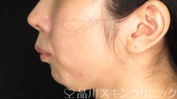 症例NO.71286のBEFORE写真