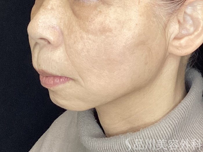 症例NO.72092のAFTER写真