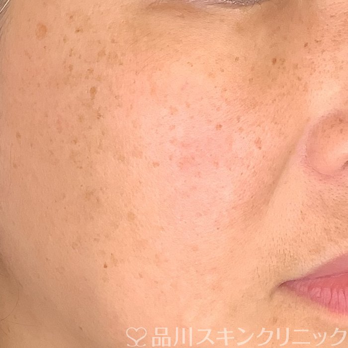 症例NO.69440のBEFORE写真