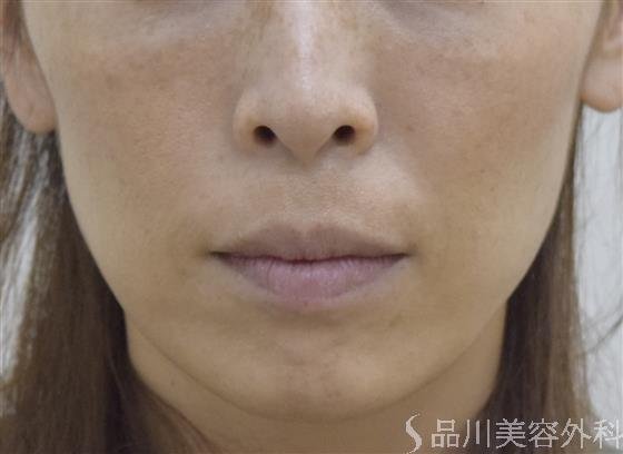 症例NO.53036のBEFORE写真