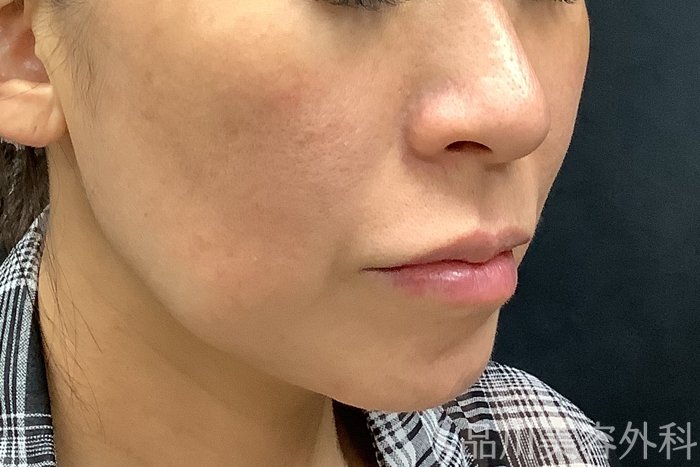 症例NO.67798のBEFORE写真