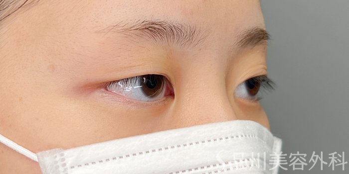 症例NO.73136のBEFORE写真