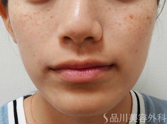 症例NO.68022のBEFORE写真