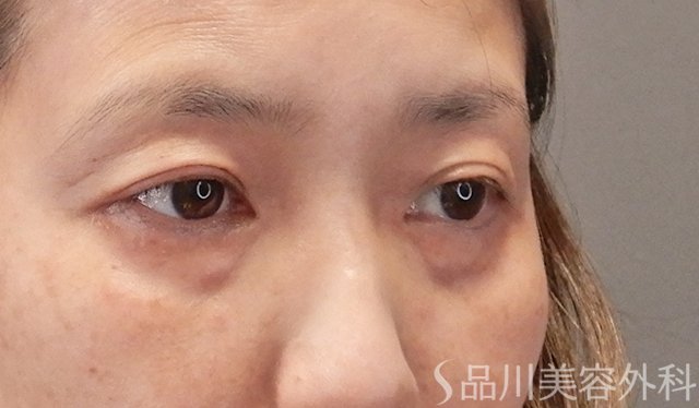 症例NO.75041のBEFORE写真