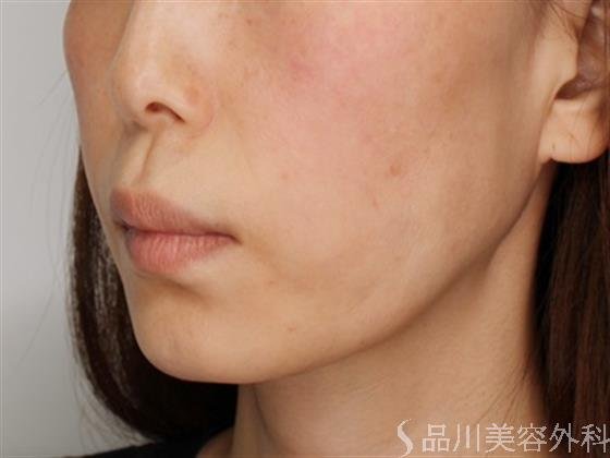 症例NO.51423のAFTER写真