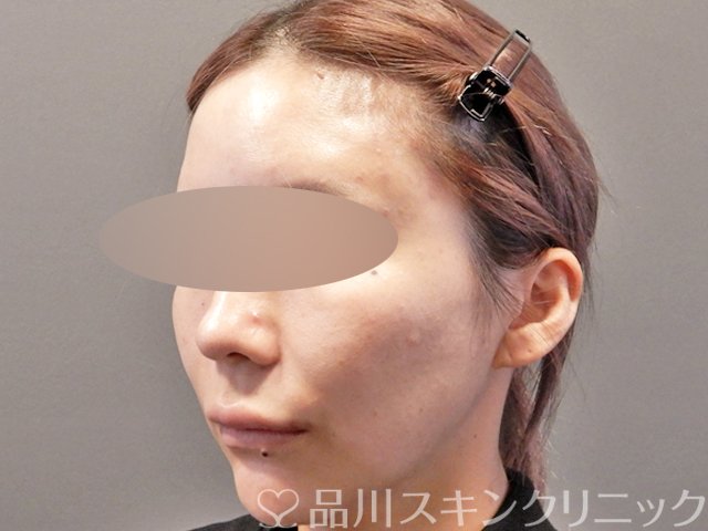 症例NO.67863のAFTER写真