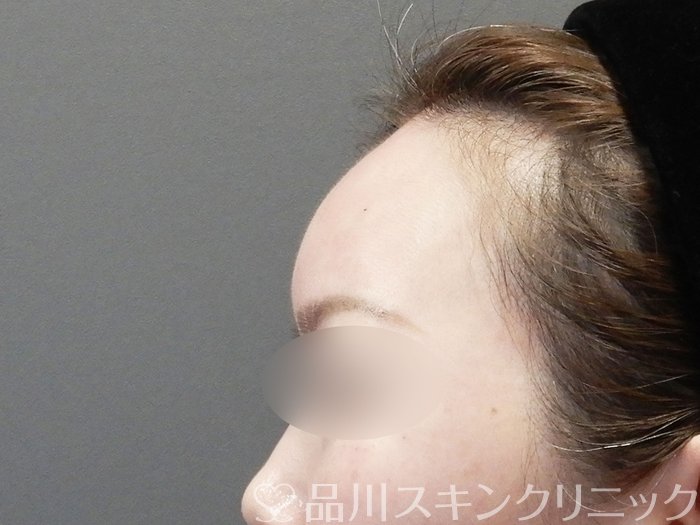 症例NO.73397のAFTER写真