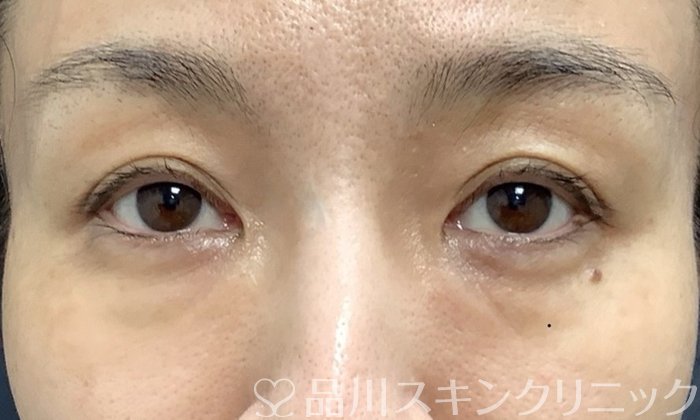 症例NO.69763のBEFORE写真