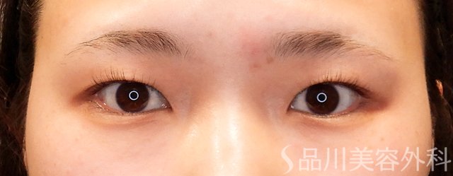 症例NO.70028のBEFORE写真