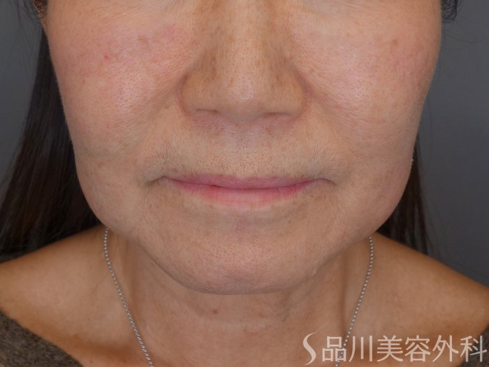 症例NO.72365のBEFORE写真