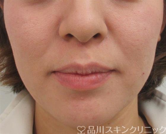 症例NO.26355のAFTER写真