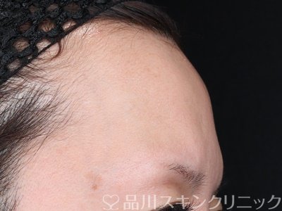 症例NO.70230のBEFORE写真