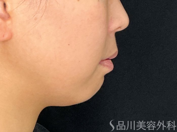 症例NO.72621のBEFORE写真