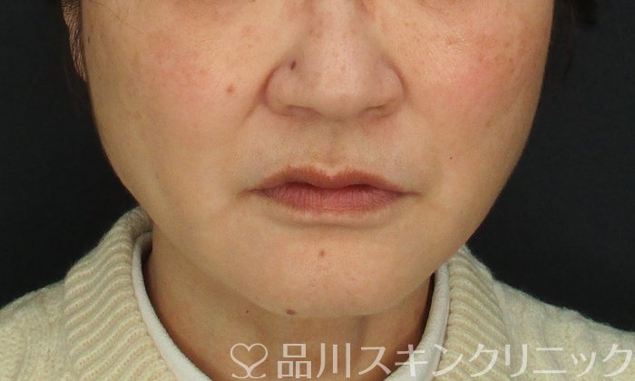 症例NO.69398のAFTER写真