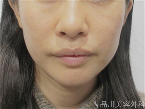 症例NO.51384のAFTER写真