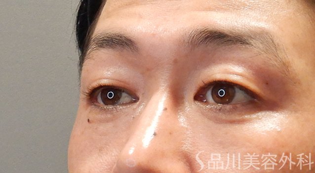 症例NO.74900のAFTER写真