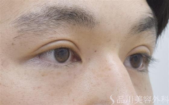 症例NO.52435のAFTER写真