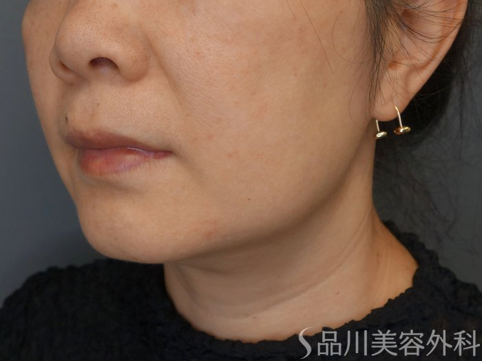 症例NO.71873のBEFORE写真