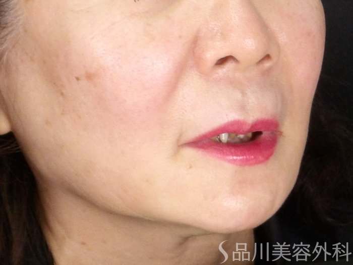 症例NO.70746のBEFORE写真