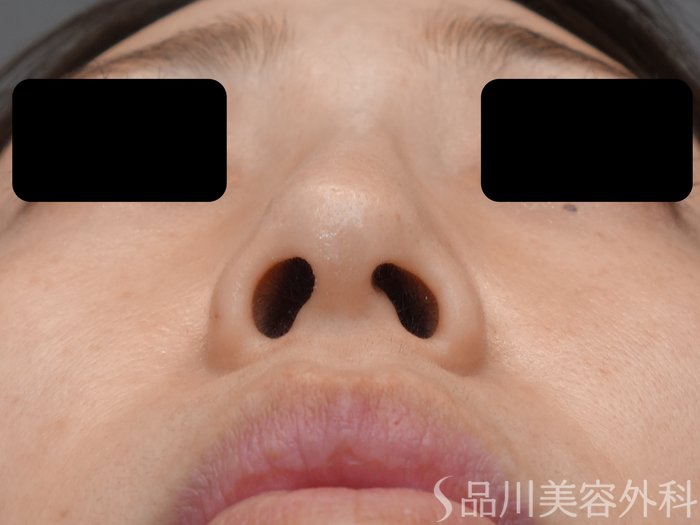 症例NO.72407のBEFORE写真