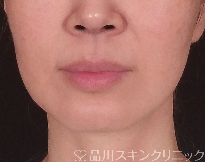 症例NO.69858のBEFORE写真