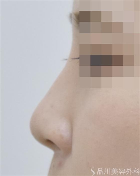 症例NO.51176のAFTER写真