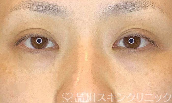 症例NO.70941のBEFORE写真