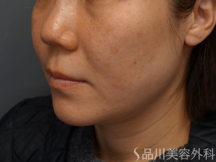症例NO.74281のBEFORE写真