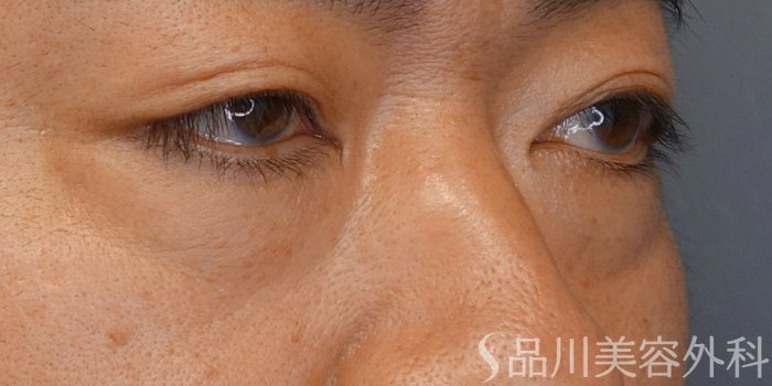 症例NO.70622のBEFORE写真