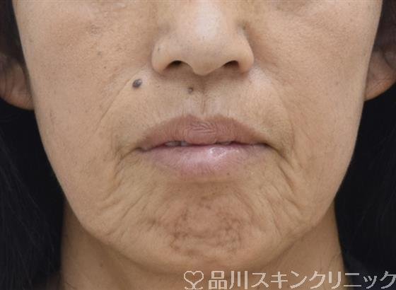 症例NO.43083のBEFORE写真