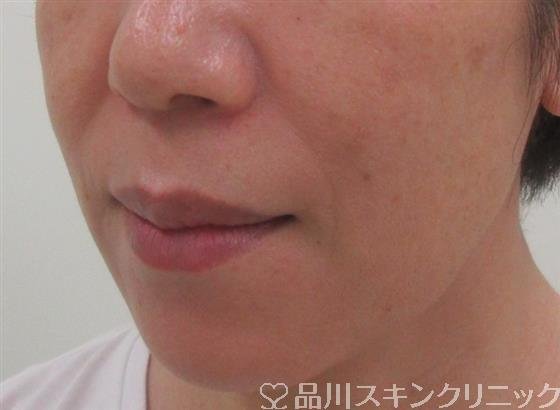 症例NO.31411のBEFORE写真