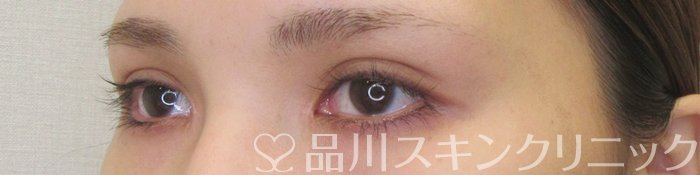 症例NO.70226のAFTER写真