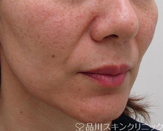 症例NO.34060のBEFORE写真