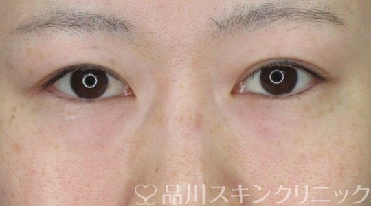 症例NO.70216のBEFORE写真