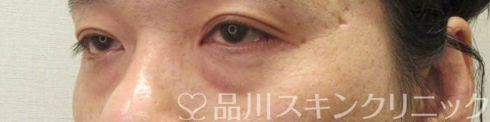 症例NO.71038のBEFORE写真